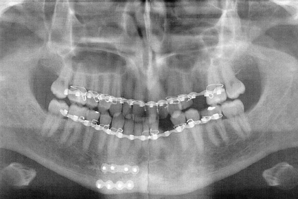 Jaw Xray
